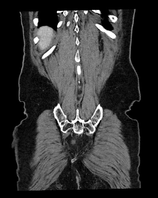 Acute appendicitis - large appendicoliths (Radiopaedia 61805-69820 Coronal C+ portal venous phase 118).jpg