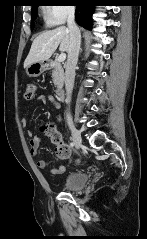 Acute appendicitis - large appendicoliths (Radiopaedia 61805-69820 Sagittal C+ portal venous phase 67).jpg