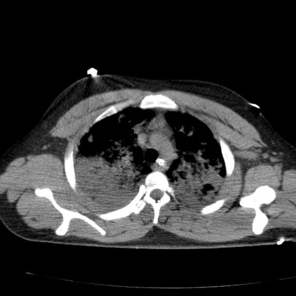 Acute aspiration pneumonitis (Radiopaedia 33605-34703 Axial non-contrast 31).jpg