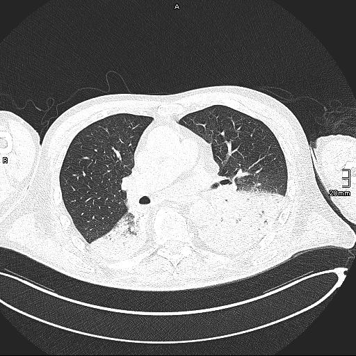 Acute aspiration pneumonitis (Radiopaedia 55642-62166 Axial lung window 77).jpg