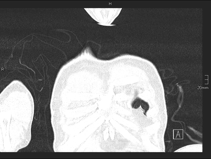 File:Acute aspiration pneumonitis (Radiopaedia 55642-62166 Coronal lung window 5).jpg