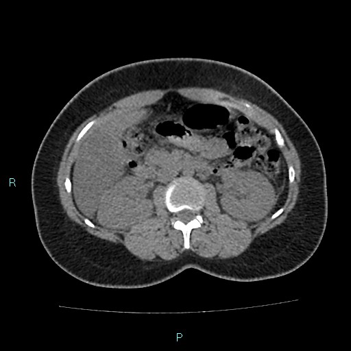 Acute bilateral pyelonephritis (Radiopaedia 37146-38881 Axial non-contrast 45).jpg