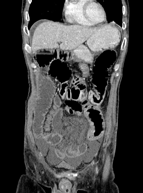 Acute bowel ischemia (Radiopaedia 87695-104114 Coronal C+ portal venous phase 129).jpg