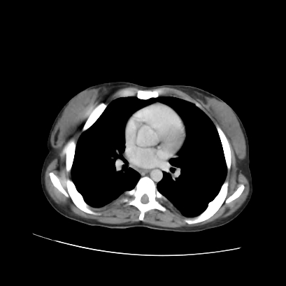 Acute calculous cholecystitis in patient with osteopetrosis (Radiopaedia 77871-90159 Axial C+ portal venous phase 5).jpg