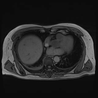 Acute cholecystitis (Radiopaedia 72392-82923 Axial T1 out-of-phase 13).jpg