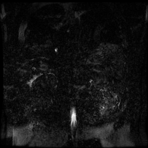 Acute cholecystitis and biliary hamartomas (Radiopaedia 86231-102240 E 3).jpg