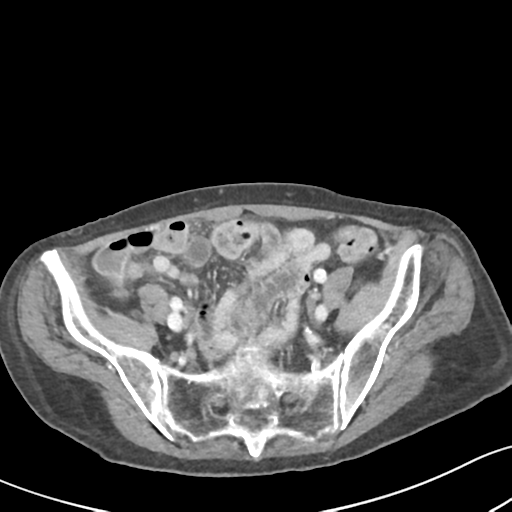Acute cholecystitis with contained perforation (Radiopaedia 47328-51907 Axial C+ portal venous phase 55).png