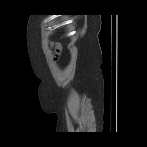 Acute cholecystitis with tensile fundus sign (Radiopaedia 71394-81723 Sagittal non-contrast 148).jpg