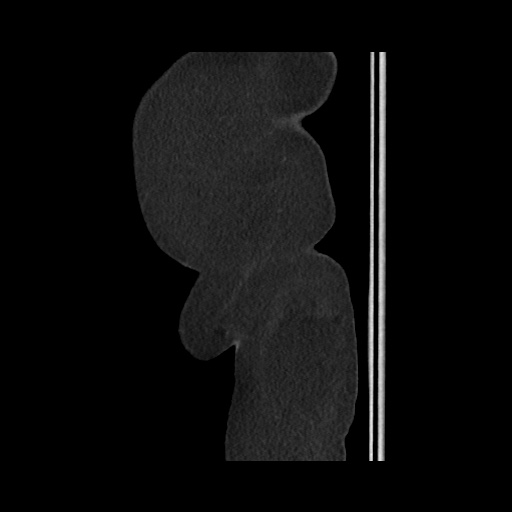 Acute cholecystitis with tensile fundus sign (Radiopaedia 71394-81723 Sagittal non-contrast 163).jpg
