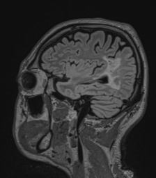 File:Acute disseminated encephalomyelitis (ADEM)- Anti-NMDA receptor encephalitis (Radiopaedia 54920-61201 Sagittal FLAIR 62).png