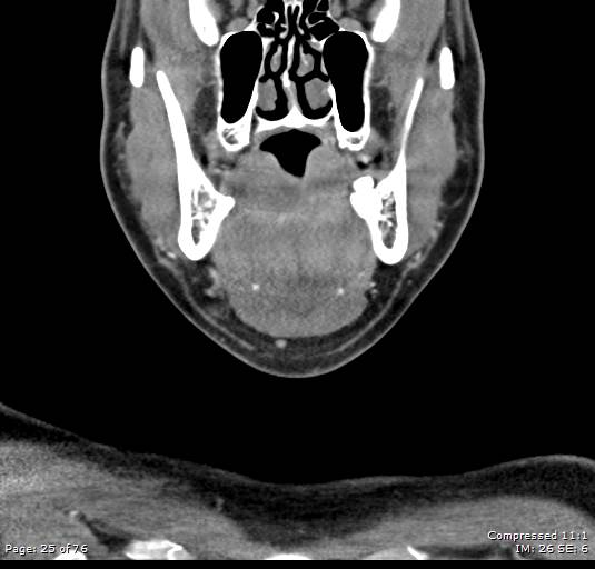File:Acute epiglottitis (Radiopaedia 54375-60590 Coronal C+ arterial phase 25).jpg