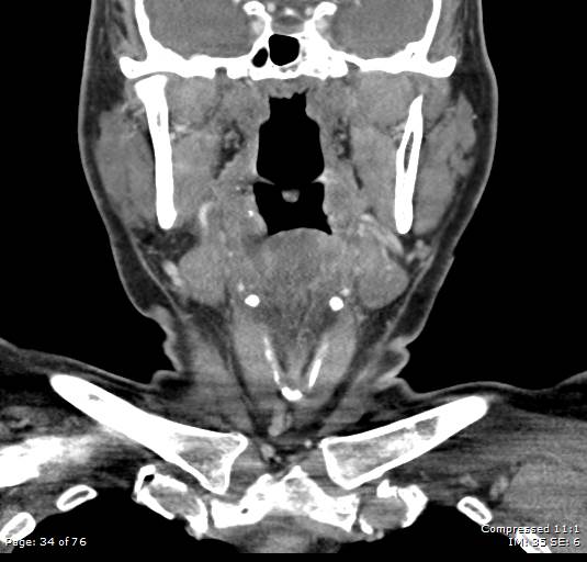 Acute epiglottitis (Radiopaedia 54375-60590 Coronal C+ arterial phase 34).jpg