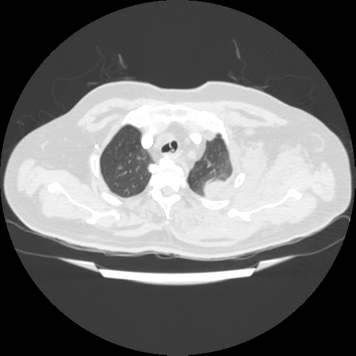 File:Acute heart failure (CT) (Radiopaedia 79835-93075 Axial lung window 7).png