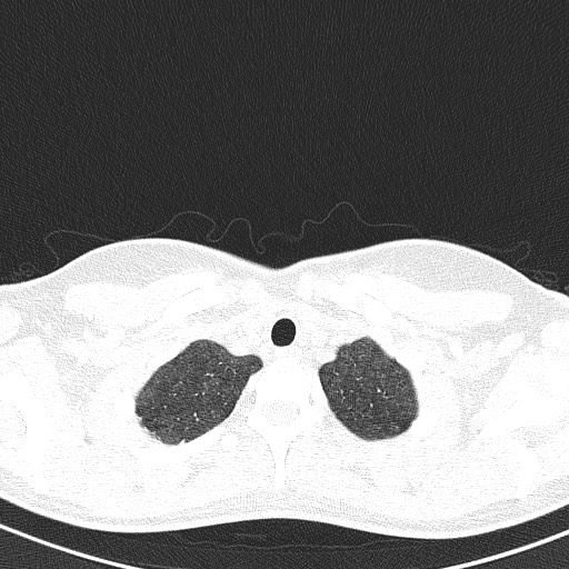 File:Acute hypersensitivity pneumonitis (Radiopaedia 85293-100870 Axial lung window 8).jpg