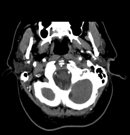 Acute internal carotid artery dissection (Radiopaedia 53541-59630 Axial C+ arterial phase 6).jpg