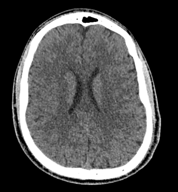 Acute ischemic stroke - posterior circulation territory (Radiopaedia 77670-89881 non-contrast 57).jpg