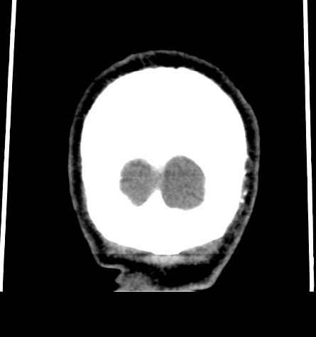Acute left anterior cerebral artery territory infarction (Radiopaedia 51785-57578 Coronal non-contrast 57).jpg