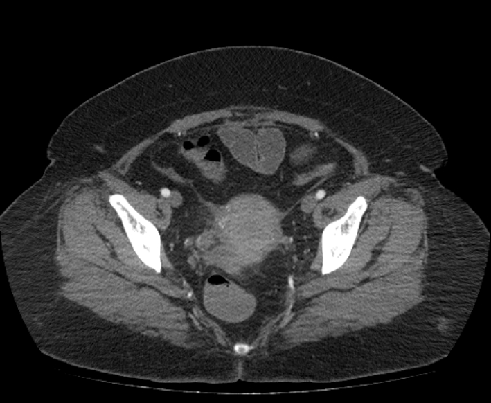 Acute mesenteric ischemia (Radiopaedia 80029-93316 Axial C+ arterial phase 117).jpg