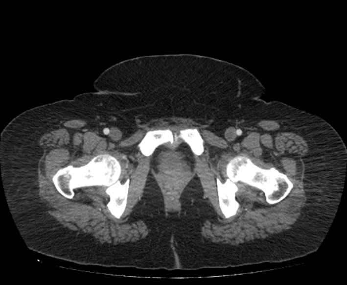 Acute mesenteric ischemia (Radiopaedia 80029-93316 Axial C+ arterial phase 135).jpg