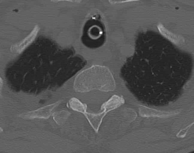 Acute on chronic subdural hematoma and thoracic vertebral injury in a multitrauma patient (Radiopaedia 31698-32619 Axial bone window 61).jpg
