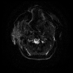 Acute otitis externa (Radiopaedia 57296-64236 Axial DWI 42).jpg