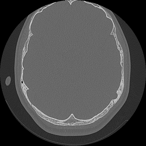 Acute otomastoiditis and Bezold abscess (Radiopaedia 88184-104786 Axial bone window 56).jpg