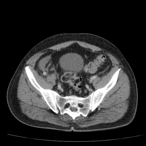Acute pancreatitis (Radiopaedia 26663-26813 Axial C+ portal venous phase 70).jpg