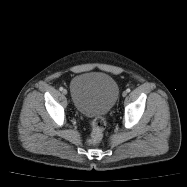 Acute pancreatitis (Radiopaedia 26663-26813 Axial C+ portal venous phase 76).jpg