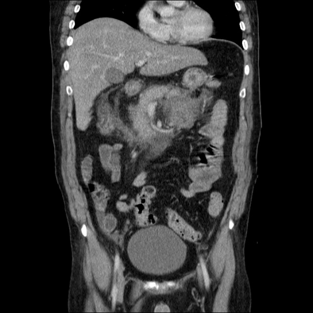Acute pancreatitis (Radiopaedia 26663-26813 Coronal C+ portal venous phase 26).jpg