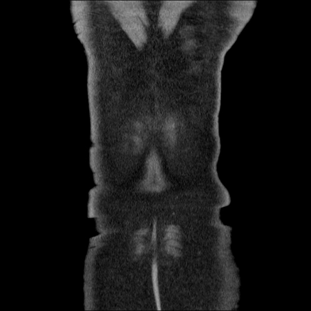 Acute pancreatitis (Radiopaedia 26663-26813 Coronal C+ portal venous phase 62).jpg