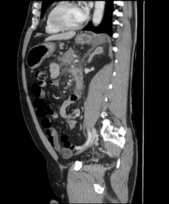 Acute pancreatitis - Balthazar E (Radiopaedia 23080-23110 Sagittal C+ portal venous phase 61).jpg