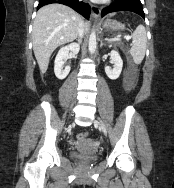 Acute pancreatitis - Balthazar E (Radiopaedia 29016-29377 Coronal C+ portal venous phase 58).png
