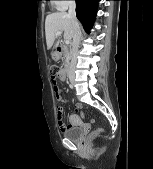 Acute pancreatitis - Balthazar E - post ERCP (Radiopaedia 27562-27772 Sagittal C+ portal venous phase 59).png