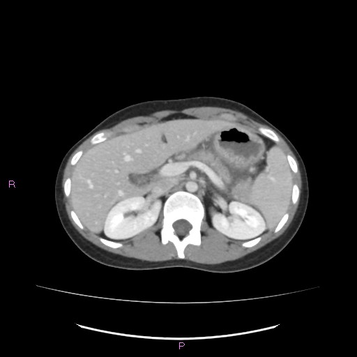 Acute pancreatitis secondary to stone at minor papilla and pancreatic divisum (Radiopaedia 76570-88333 Axial C+ portal venous phase 24).jpg