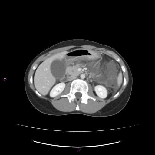 Acute pancreatitis secondary to stone at minor papilla and pancreatic divisum (Radiopaedia 76570-88333 Axial C+ portal venous phase 32).jpg