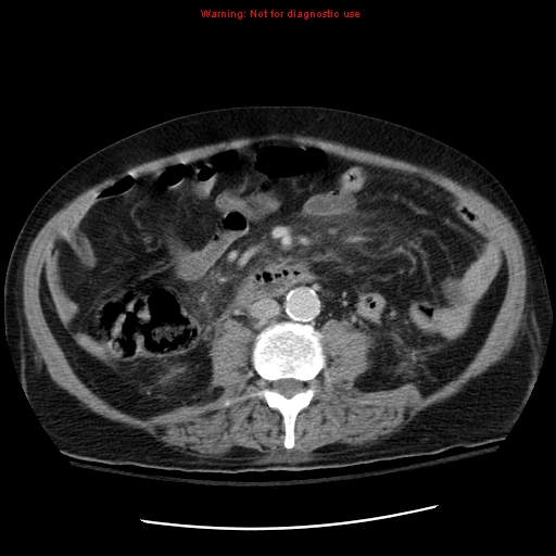 File:Acute pancreatitis with incidental pancreatic lipoma (Radiopaedia 10190-10730 Axial C+ portal venous phase 41).jpg