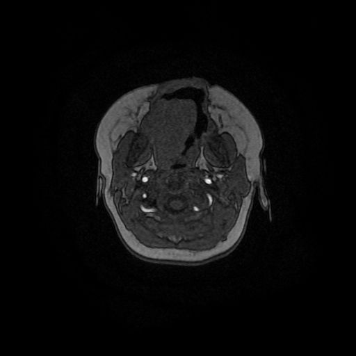 Acute phase of hemiconvulsion-hemiplegia epilepsy syndrome (Radiopaedia 29309-29745 Axial TOF angiography 164).jpg