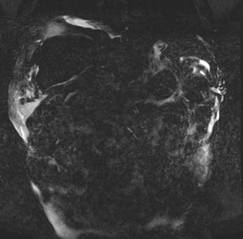 Acute portal vein thrombosis (Radiopaedia 73198-83925 Coronal Heavily T2 thin cuts 63).jpg