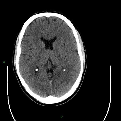 File:Acute posterior cerebral artery territory infarct (Radiopaedia 79329-92393 Axial non-contrast 56).jpg