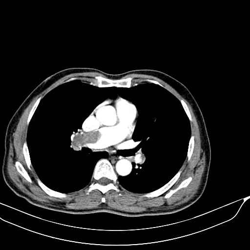 File:Acute pulmonary embolism (Radiopaedia 69510-79390 Axial C+ arterial phase 1).jpg