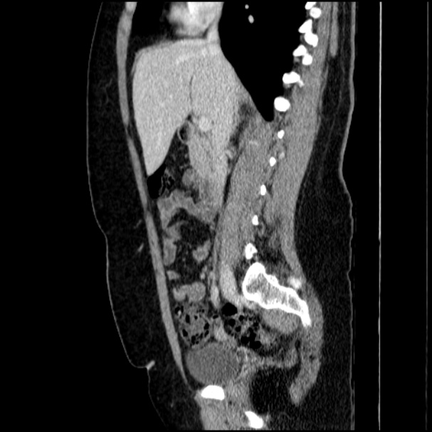 Acute pyelonephritis (Radiopaedia 33397-34434 Sagittal renal parenchymal phase 39).jpg