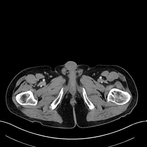File:Acute renal infarction (Radiopaedia 59375-66736 Axial C+ portal venous phase 134).jpg