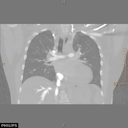 File:Acute reversible pulmonary hypertension and right heart failure from cocaine toxicity (Radiopaedia 49394-54517 Coronal C+ CTPA 23).jpg