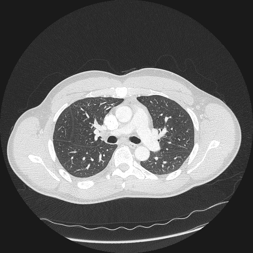 Acute segmental pulmonary emboli and pulmonary infarction (Radiopaedia 62264-70444 Axial lung window 72).jpg