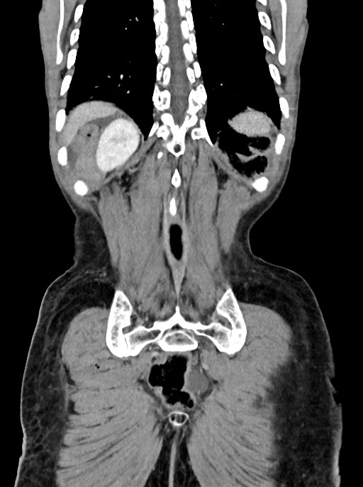 Acute small bowel (ileal) volvulus (Radiopaedia 71740-82139 Coronal C+ portal venous phase 96).jpg