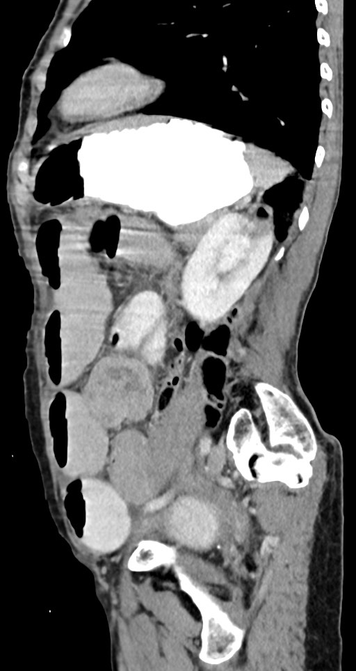 Acute small bowel (ileal) volvulus (Radiopaedia 71740-82139 Sagittal C+ portal venous phase 60).jpg