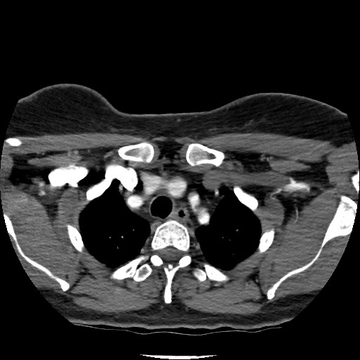 Acute subarachnoid hemorrhage and accessory anterior cerebral artery (Radiopaedia 69231-79009 Axial C+ arterial phase 21).jpg