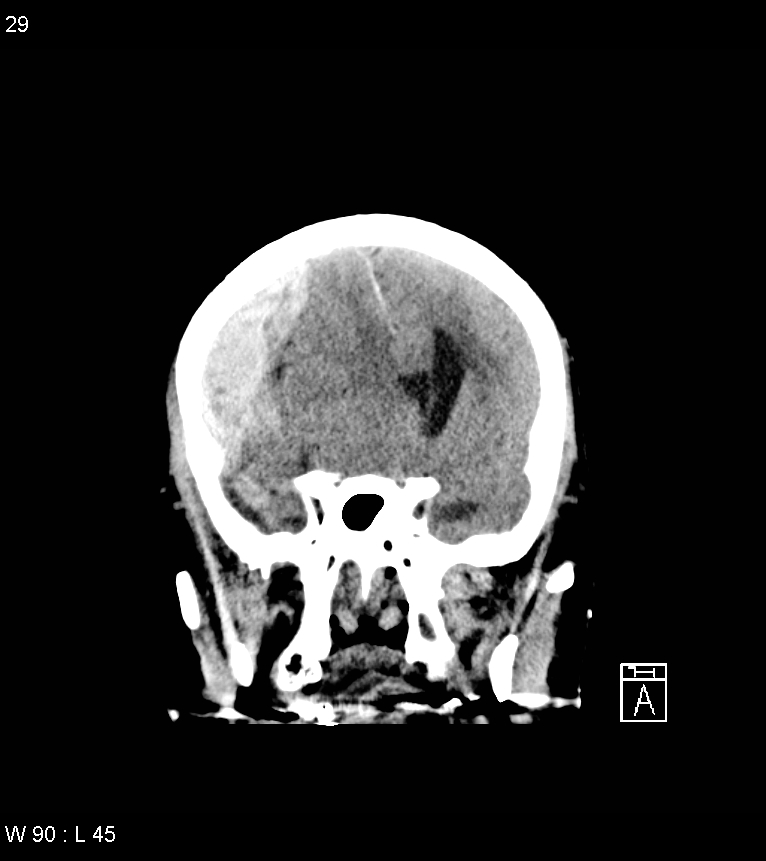 Acute subdural hematoma with myelofibrosis (Radiopaedia 52582-58494 Coronal non-contrast 20).jpg
