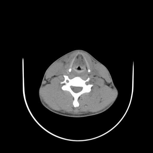 File:Acute submandibular sialadenitis secondary to ductal stone (Radiopaedia 27999-28267 Axial non-contrast 23).jpg