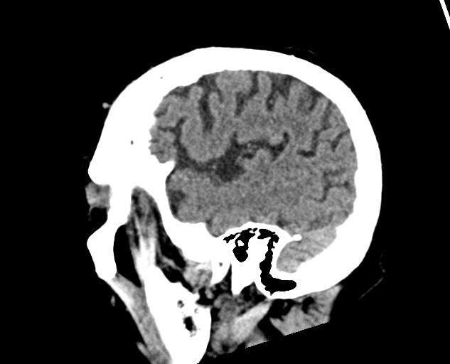 Acute traumatic subdural hematoma (Radiopaedia 82921-97257 Sagittal non-contrast 57).jpg